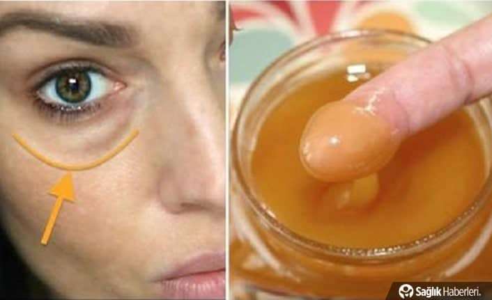 Göz altı morlukları doğal olarak nasıl geçer? Ne iyi gelir?
