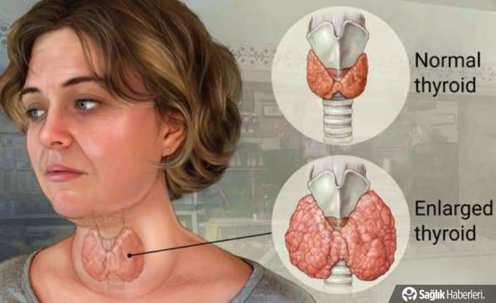 Guatr nedir? Guatrın belirtileri ve tedavi yöntemleri nelerdir?