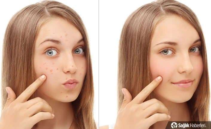 Yüz lekeleri için 7 doğal maske tarifi