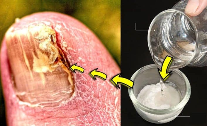 Ayak Tırnağı Mantarı Doğal Tedavisi Nasıl Yapılır Ne İyi Gelir