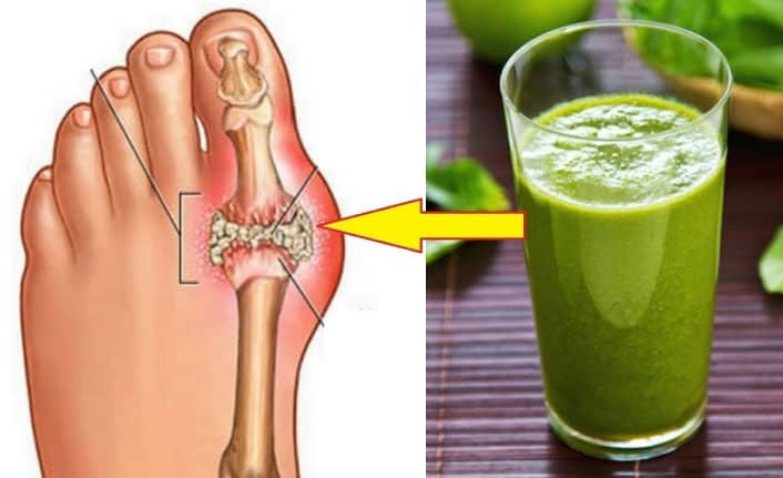 Gut Hastalığı Nedir? Gut Hastalığı Belirtileri Nelerdir?
