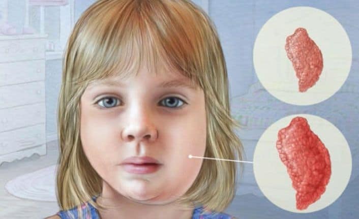 Kabakulak Nedir, Neden Olur? Bulaşıcı Mıdır? Belirtileri, Tedavisi, Aşısı