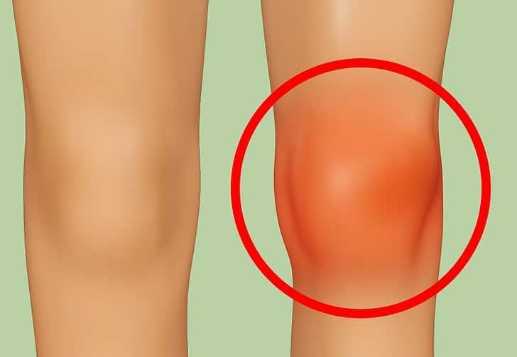 Menisküs Yırtılması Nedir Neden Olur