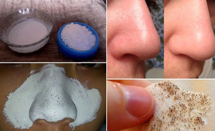 Yüzdeki Siyah Noktalar Nasıl Temizlenir En Etkili Siyah Nokta Maskeleri