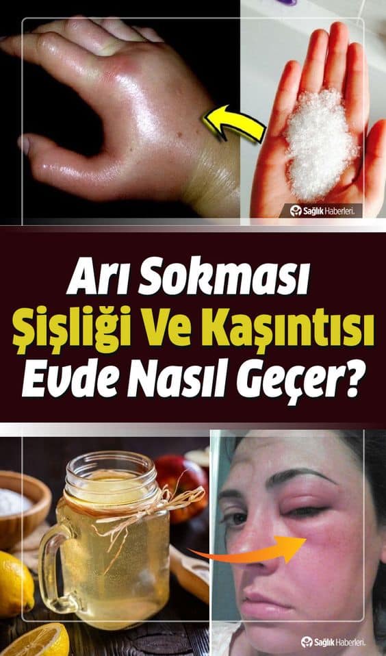 Arı Sokmasına Ne İyi Gelir? Arı Sokması Şişliği ve Kaşıntısı Evde Nasıl Geçer?