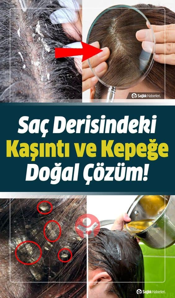 Saç Derisinde Kızarıklık ve Kaşıntısı Neden Olur? Ne İyi Gelir, Nasıl Geçer?